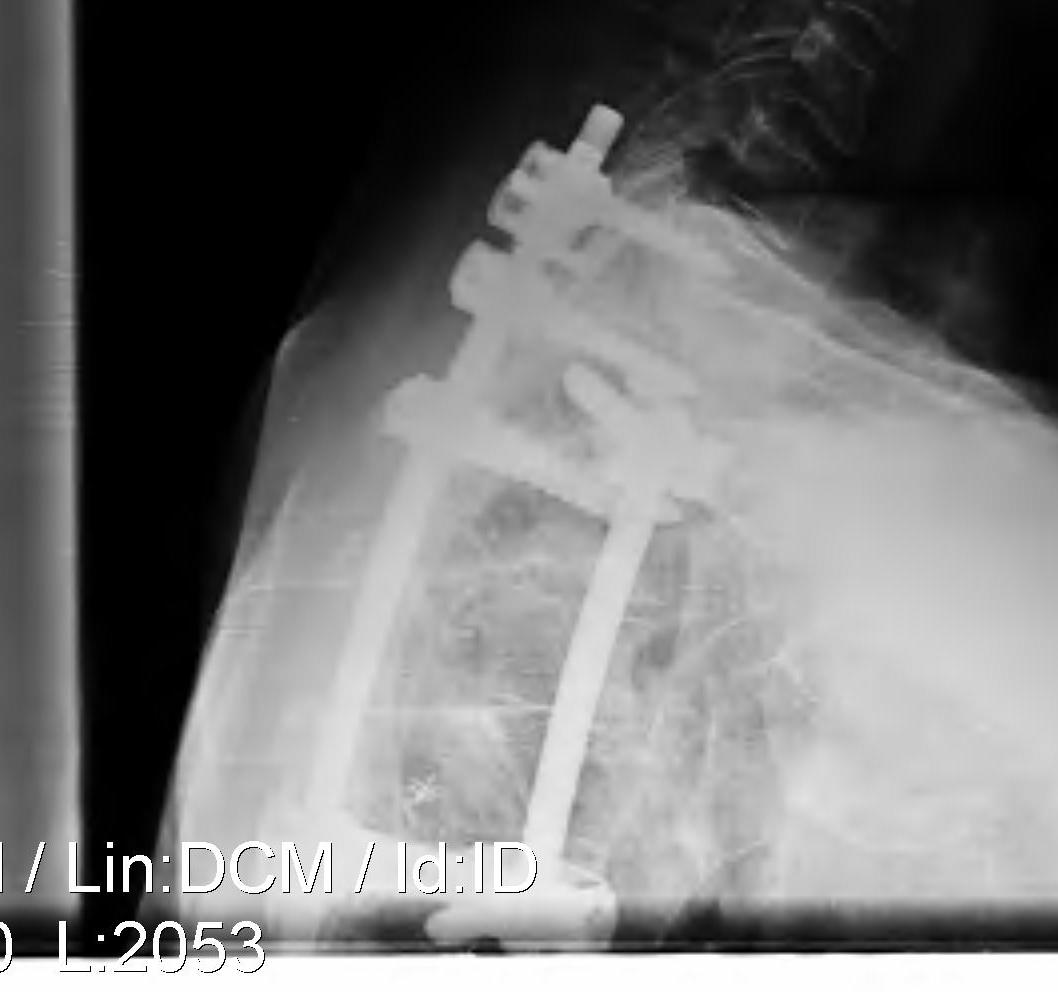 Thoracic Corpectomy HNP